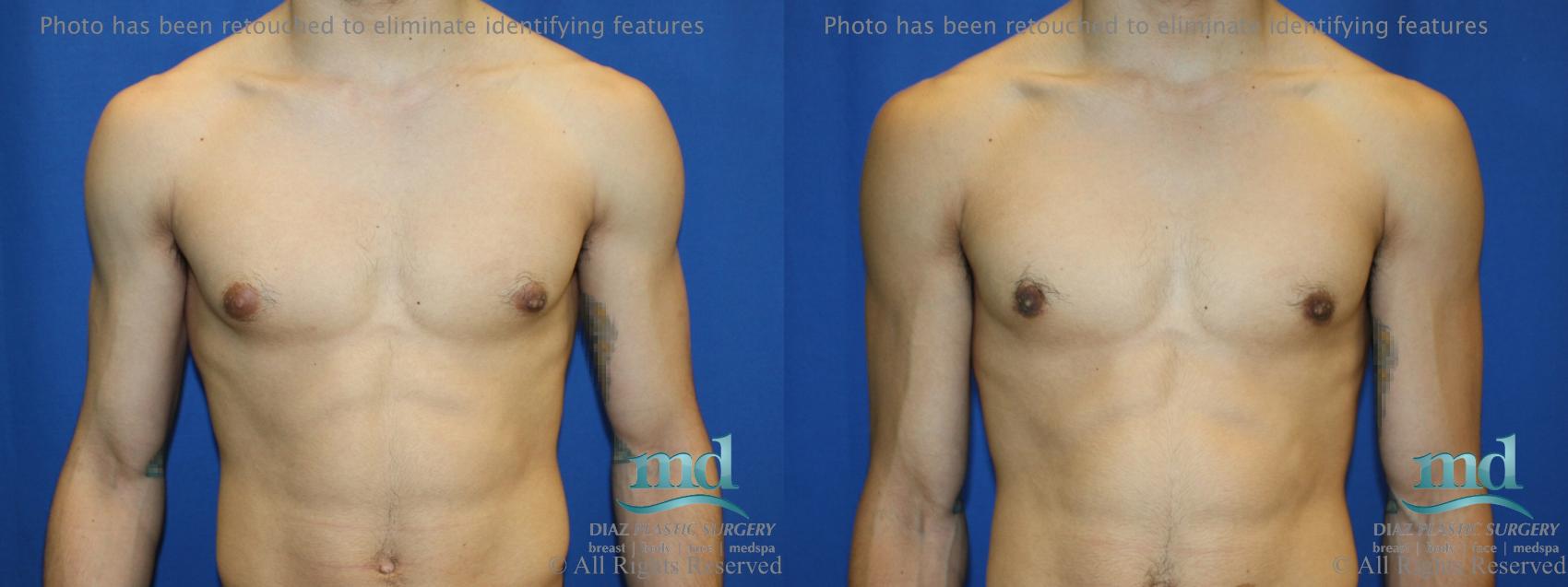 Before & After Gynecomastia Case 111 View #1 View in Melbourne, FL