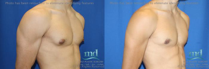 Before & After Gynecomastia Case 111 View #2 View in Melbourne, FL
