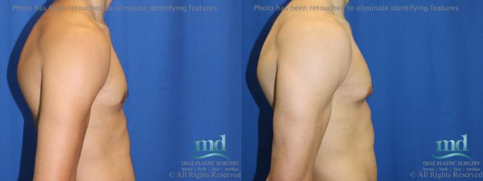 Before & After Gynecomastia Case 111 View #3 View in Melbourne, FL
