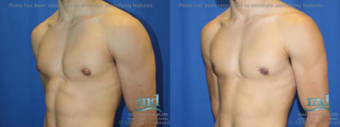 Before & After Gynecomastia Case 111 View #4 View in Melbourne, FL