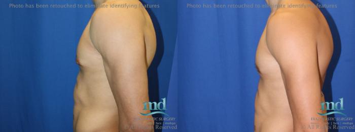 Before & After Gynecomastia Case 111 View #5 View in Melbourne, FL