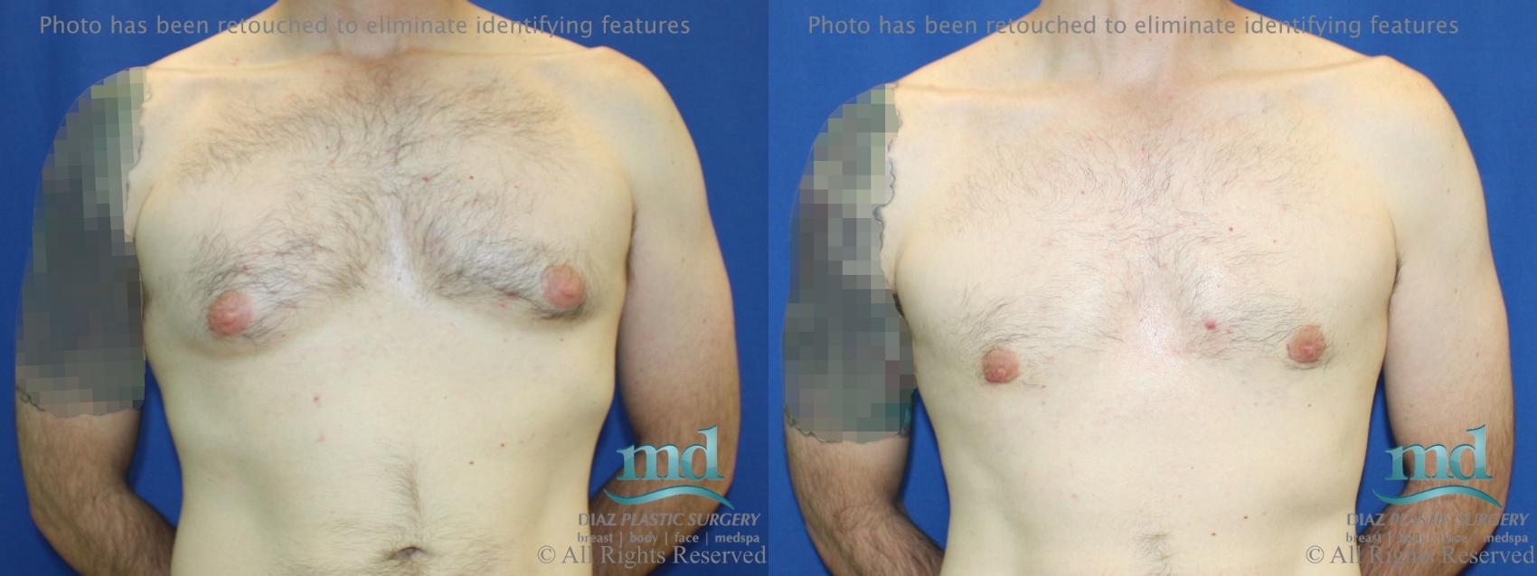 Before & After Gynecomastia Case 112 View #1 View in Melbourne, FL