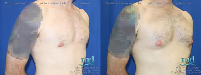 Before & After Gynecomastia Case 112 View #2 View in Melbourne, FL