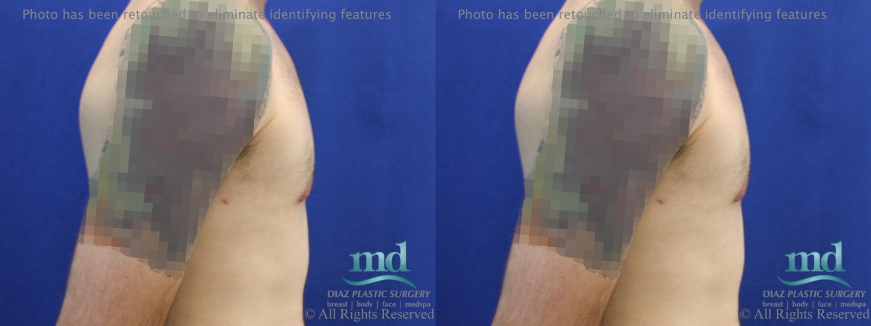 Before & After Gynecomastia Case 112 View #3 View in Melbourne, FL