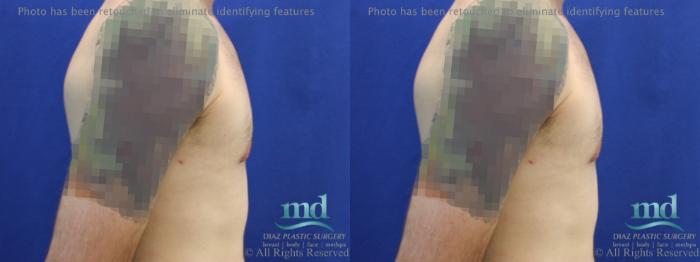 Before & After Gynecomastia Case 112 View #3 View in Melbourne, FL