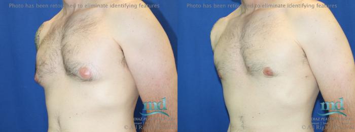 Before & After Gynecomastia Case 112 View #4 View in Melbourne, FL