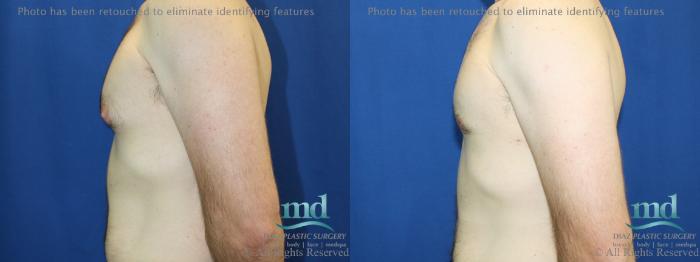 Before & After Gynecomastia Case 112 View #5 View in Melbourne, FL