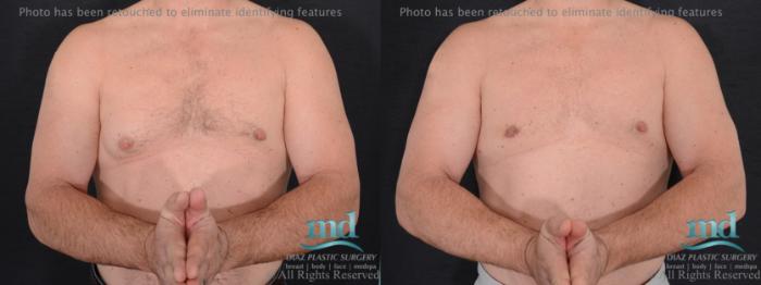 Before & After Gynecomastia Case 113 View #1 View in Melbourne, FL