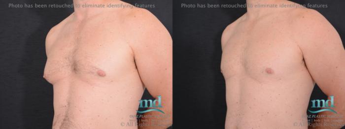 Before & After Gynecomastia Case 113 View #2 View in Melbourne, FL