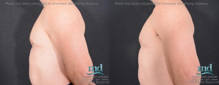 Before & After Gynecomastia Case 113 View #3 View in Melbourne, FL