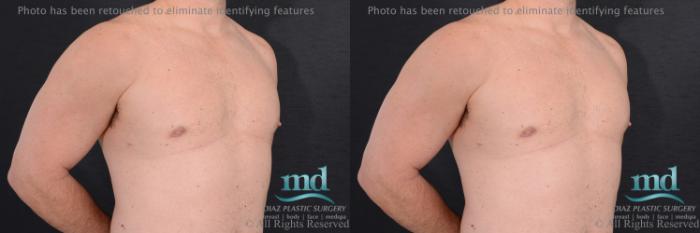 Before & After Gynecomastia Case 113 View #4 View in Melbourne, FL