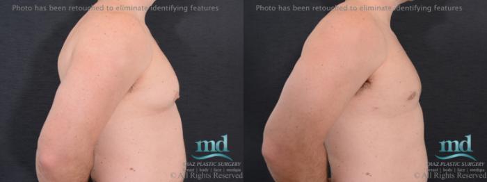 Before & After Gynecomastia Case 113 View #5 View in Melbourne, FL