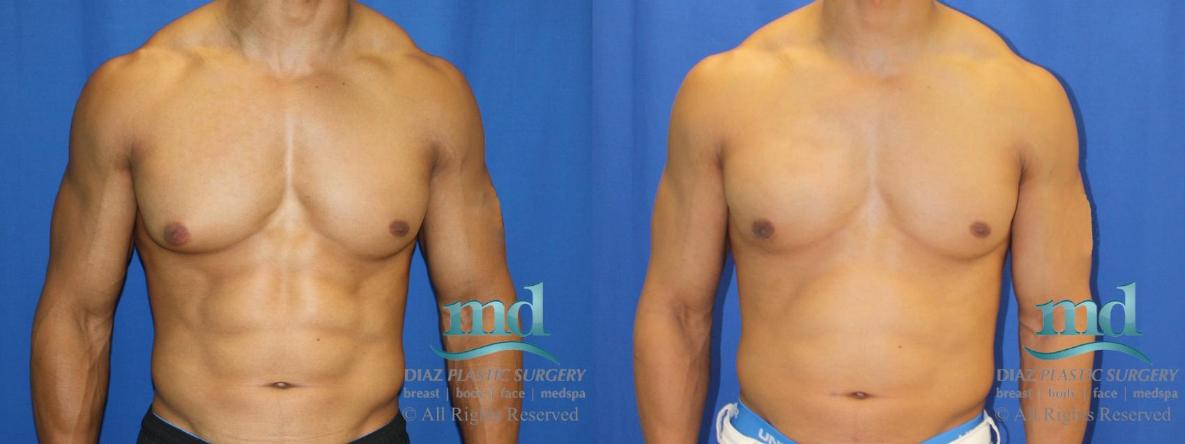 Before & After Gynecomastia Case 114 View #1 View in Melbourne, FL