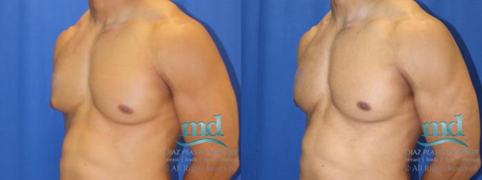 Before & After Gynecomastia Case 114 View #2 View in Melbourne, FL