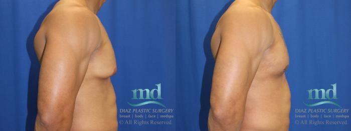 Before & After Gynecomastia Case 114 View #3 View in Melbourne, FL