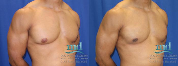 Before & After Gynecomastia Case 114 View #4 View in Melbourne, FL