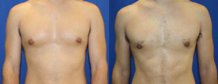 Before & After Gynecomastia Case 29 View #1 View in Melbourne, FL