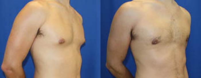 Before & After Gynecomastia Case 29 View #2 View in Melbourne, FL