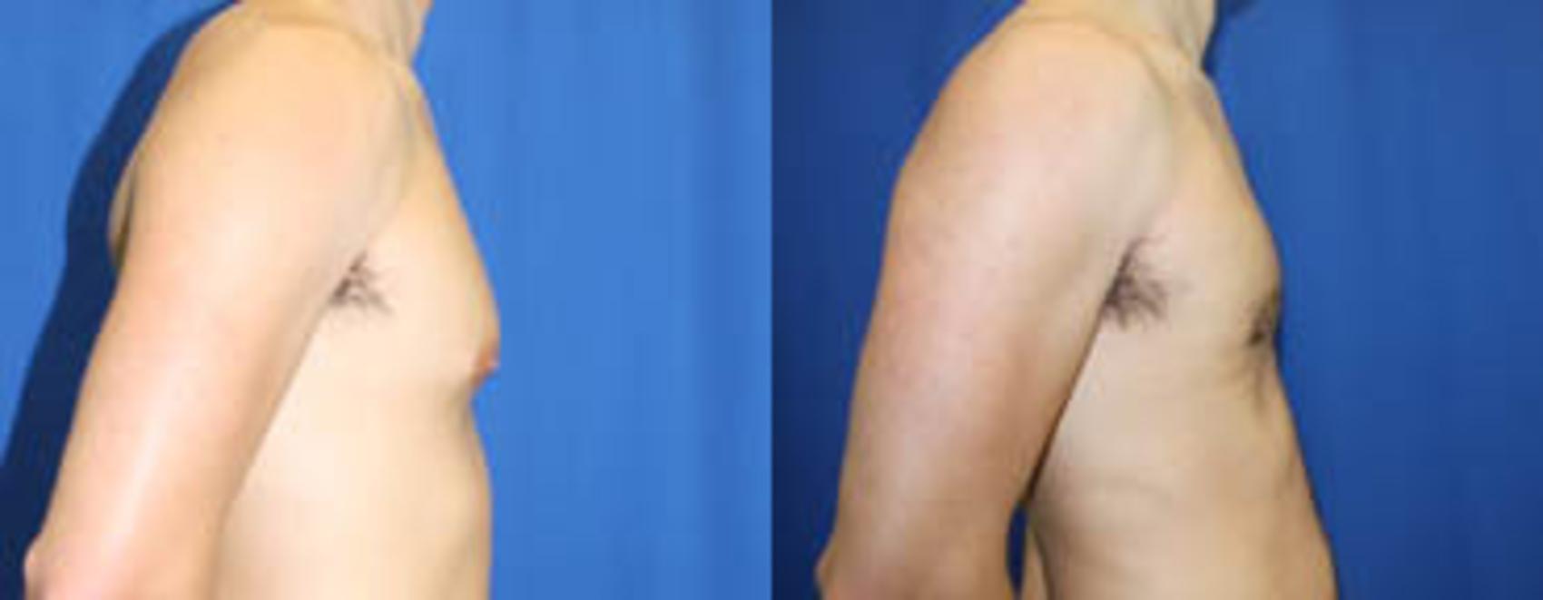 Before & After Gynecomastia Case 29 View #3 View in Melbourne, FL
