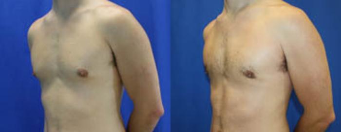 Before & After Gynecomastia Case 29 View #4 View in Melbourne, FL