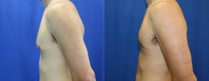 Before & After Gynecomastia Case 29 View #5 View in Melbourne, FL