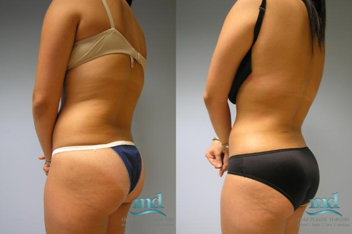 Before & After Liposuction Case 10 View #2 View in Melbourne, FL