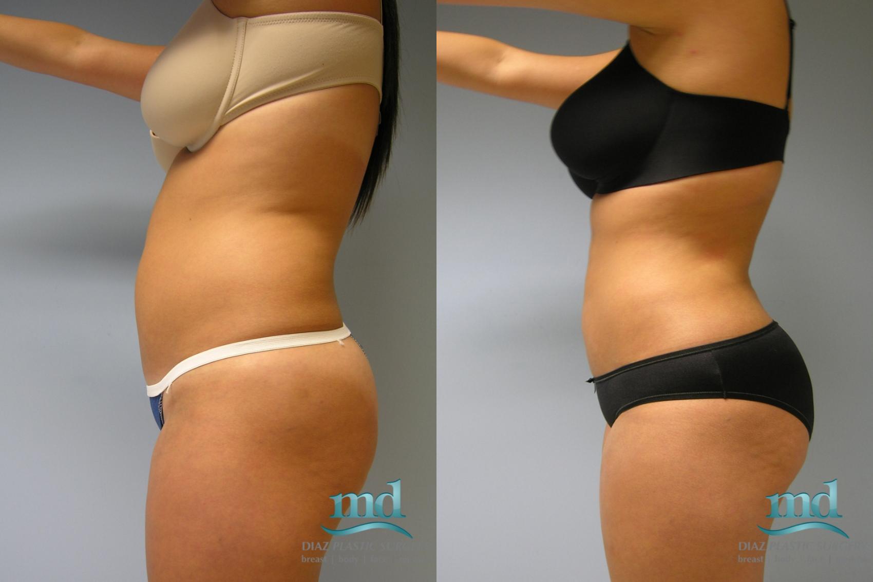 Before & After Liposuction Case 10 View #3 View in Melbourne, FL