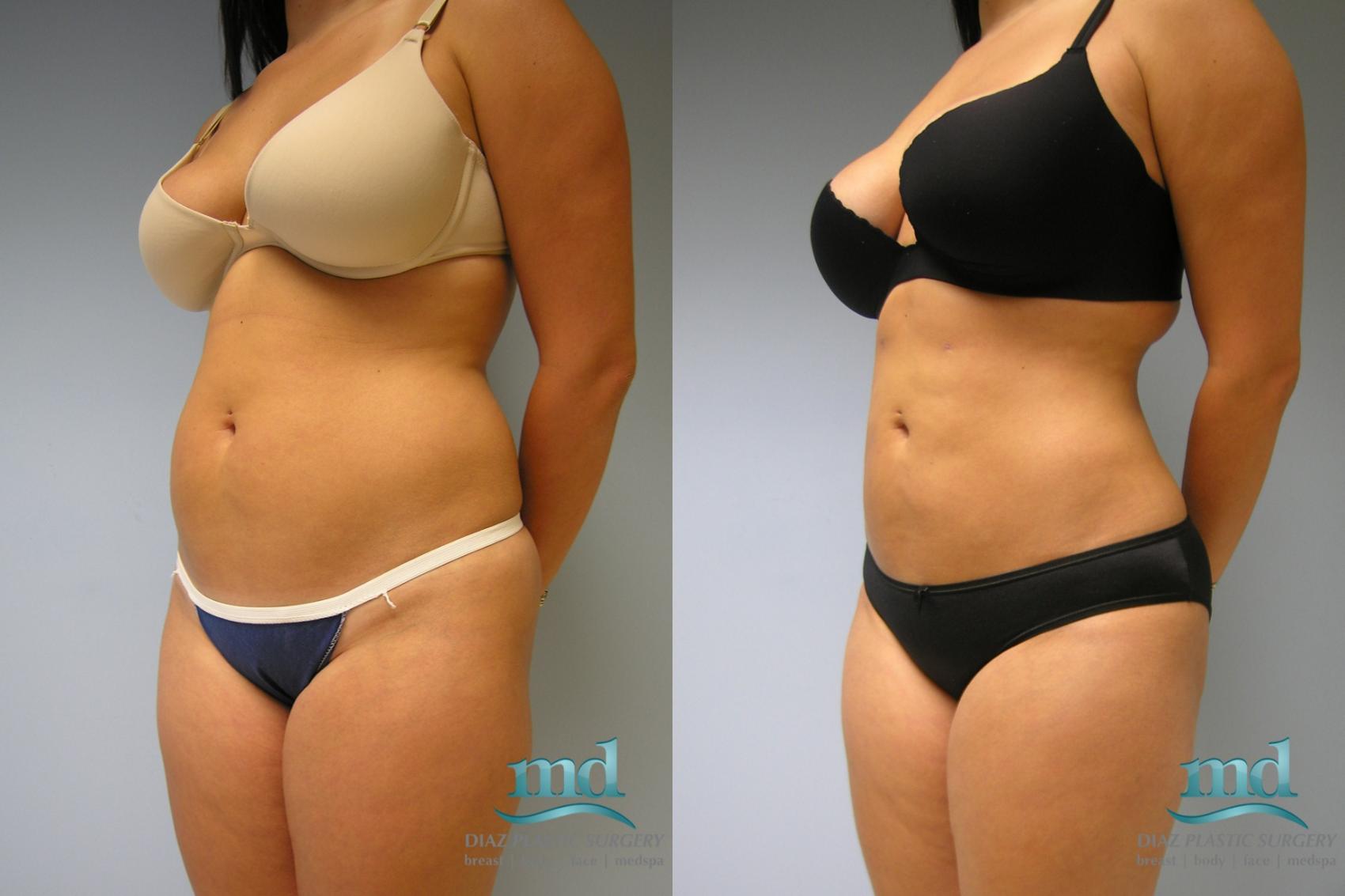 Before & After Liposuction Case 10 View #4 View in Melbourne, FL