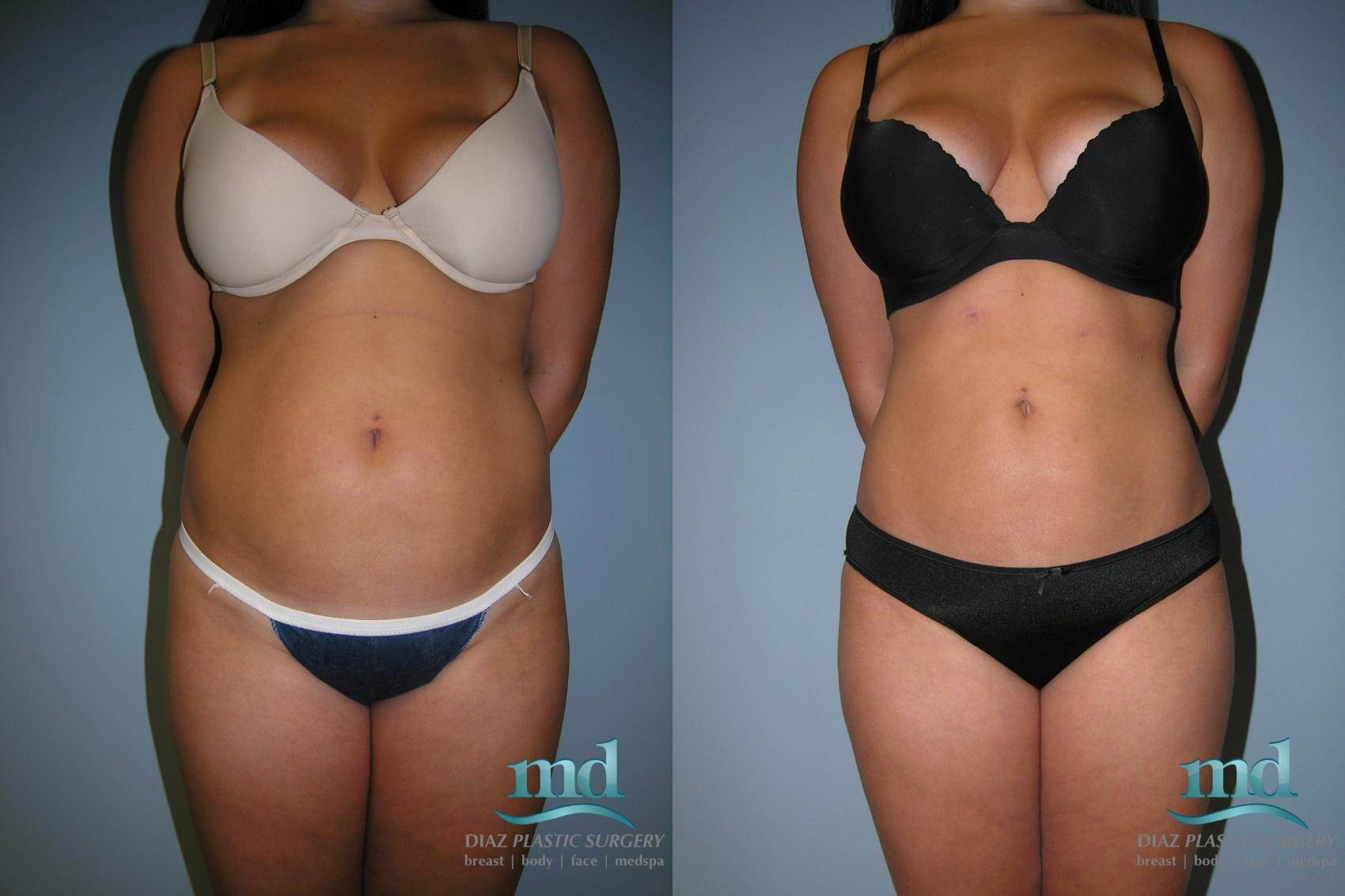 Before & After Liposuction Case 10 View #5 View in Melbourne, FL