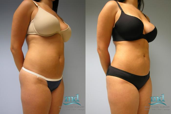 Before & After Liposuction Case 10 View #6 View in Melbourne, FL