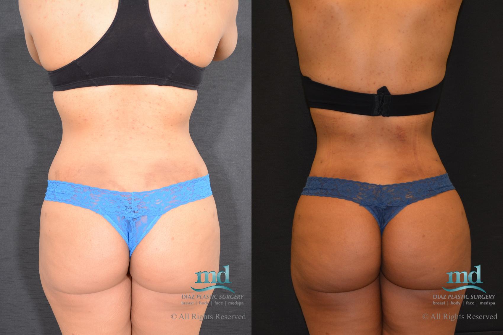 Before & After Liposuction Case 117 View #1 View in Melbourne, FL
