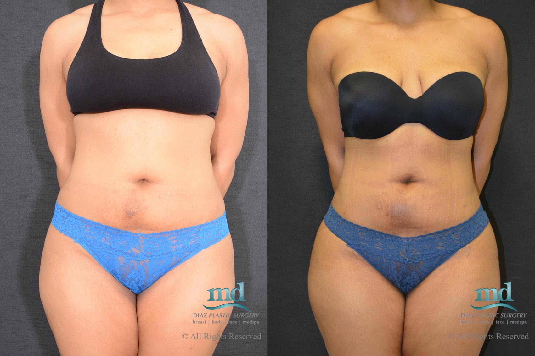 Before & After Liposuction Case 117 View #2 View in Melbourne, FL
