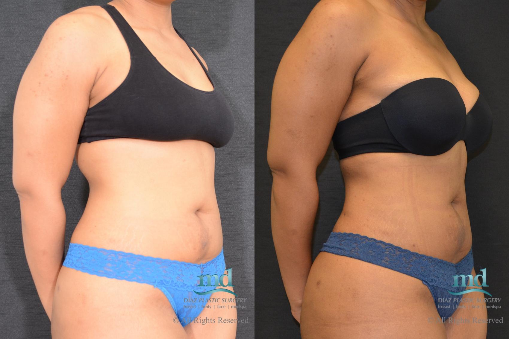 Before & After Liposuction Case 117 View #3 View in Melbourne, FL