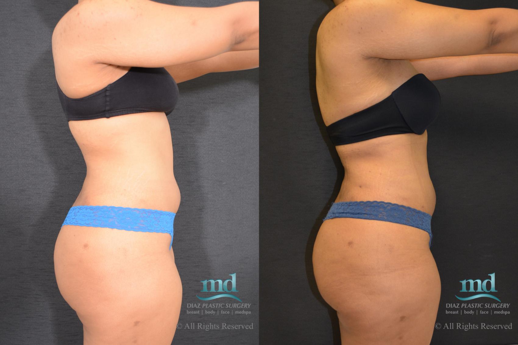 Before & After Liposuction Case 117 View #4 View in Melbourne, FL