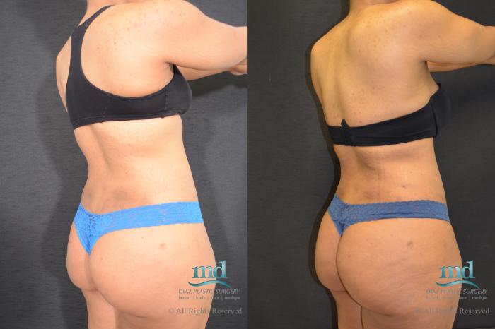 Before & After Liposuction Case 117 View #5 View in Melbourne, FL