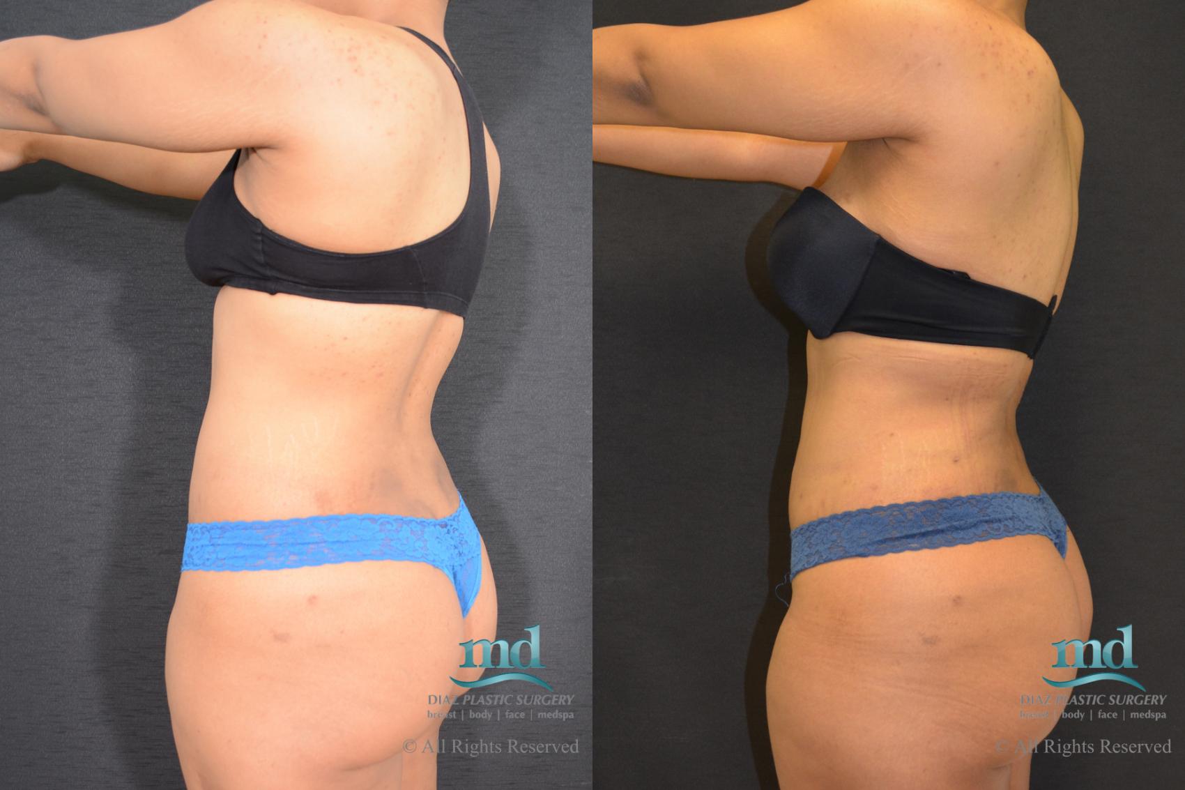 Before & After Liposuction Case 117 View #6 View in Melbourne, FL