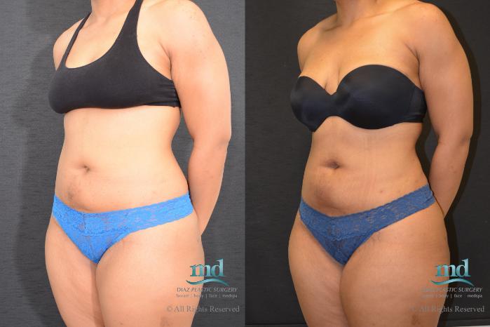 Before & After Liposuction Case 117 View #7 View in Melbourne, FL