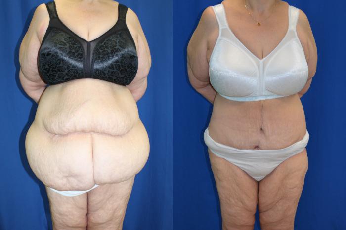 Before & After Liposuction Case 118 View #1 View in Melbourne, FL