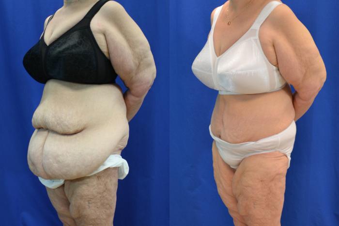 Before & After Liposuction Case 118 View #2 View in Melbourne, FL