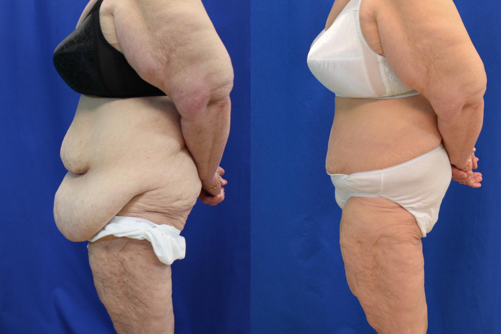 Before & After Liposuction Case 118 View #3 View in Melbourne, FL
