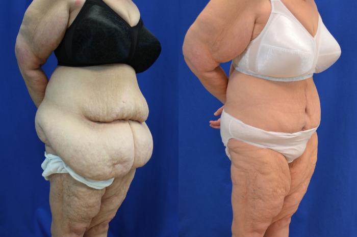 Before & After Liposuction Case 118 View #4 View in Melbourne, FL