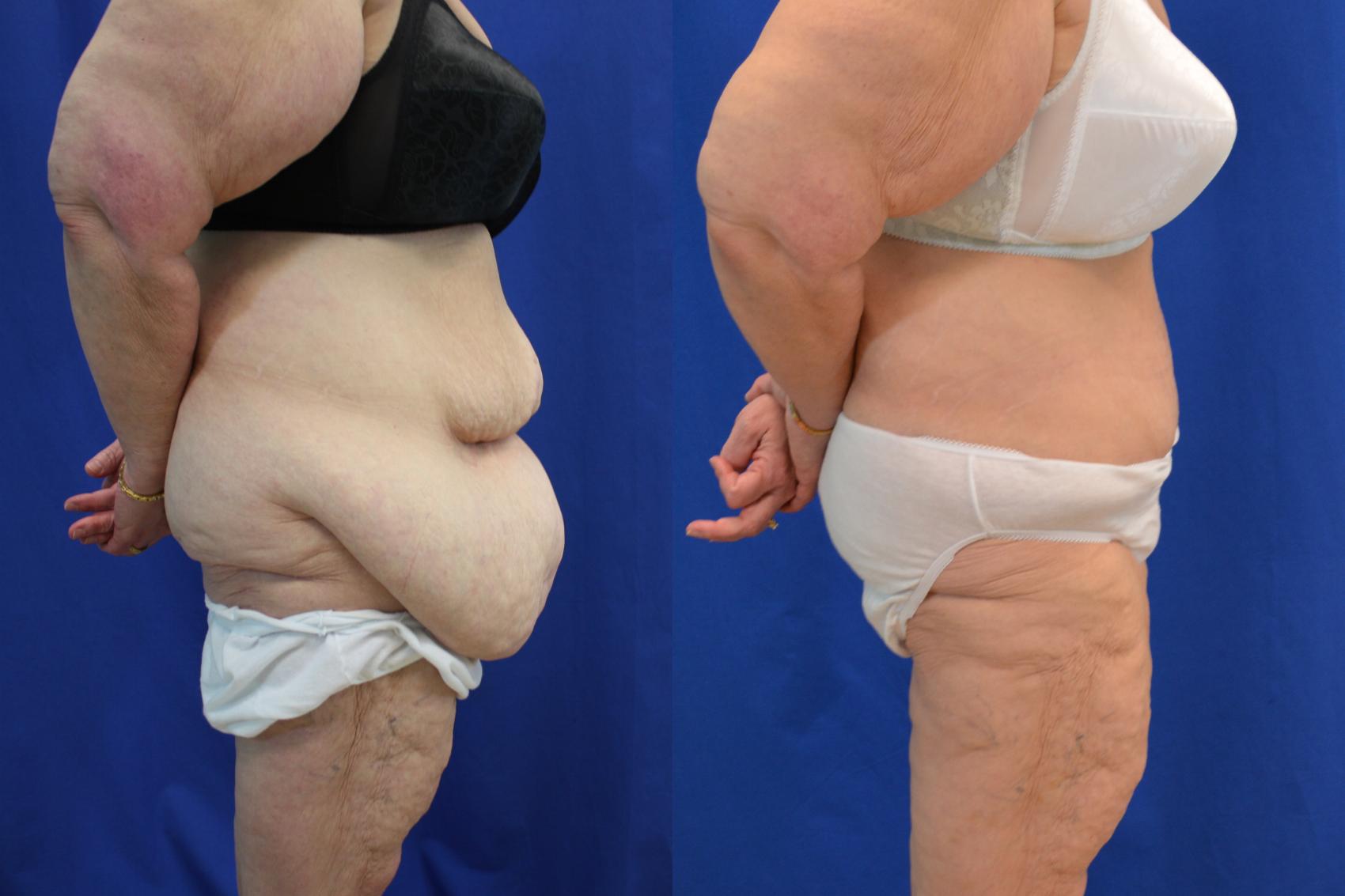 Before & After Liposuction Case 118 View #5 View in Melbourne, FL