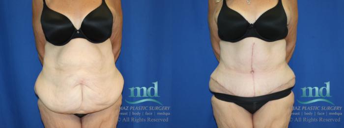 Before & After Liposuction Case 119 View #1 View in Melbourne, FL