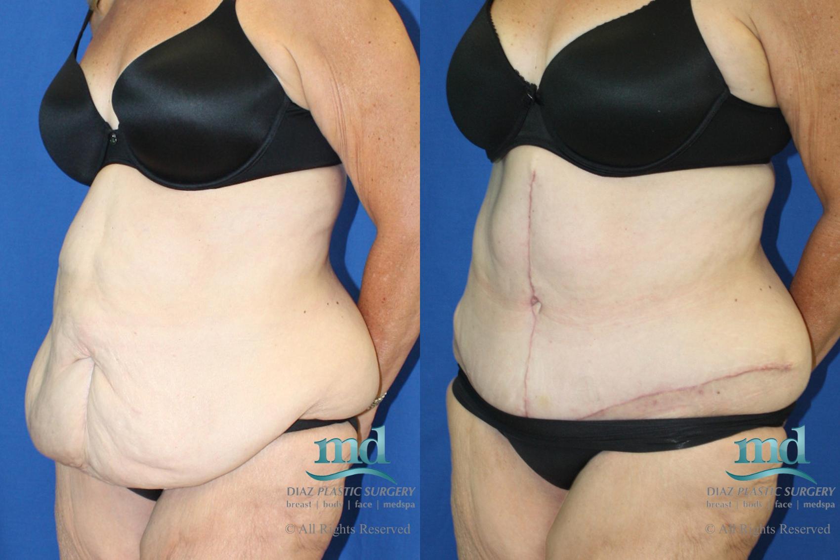 Before & After Liposuction Case 119 View #2 View in Melbourne, FL
