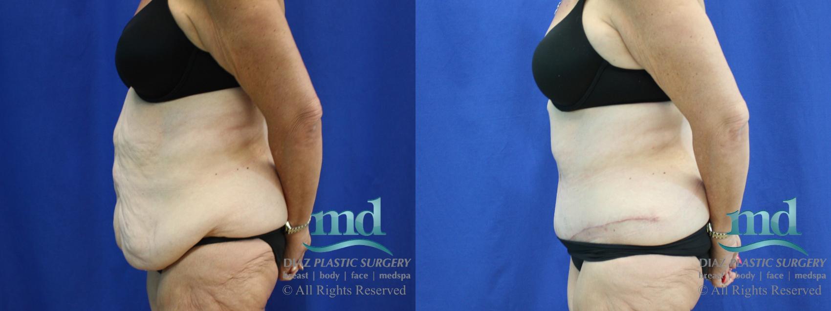Before & After Liposuction Case 119 View #3 View in Melbourne, FL