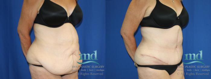 Before & After Liposuction Case 119 View #4 View in Melbourne, FL