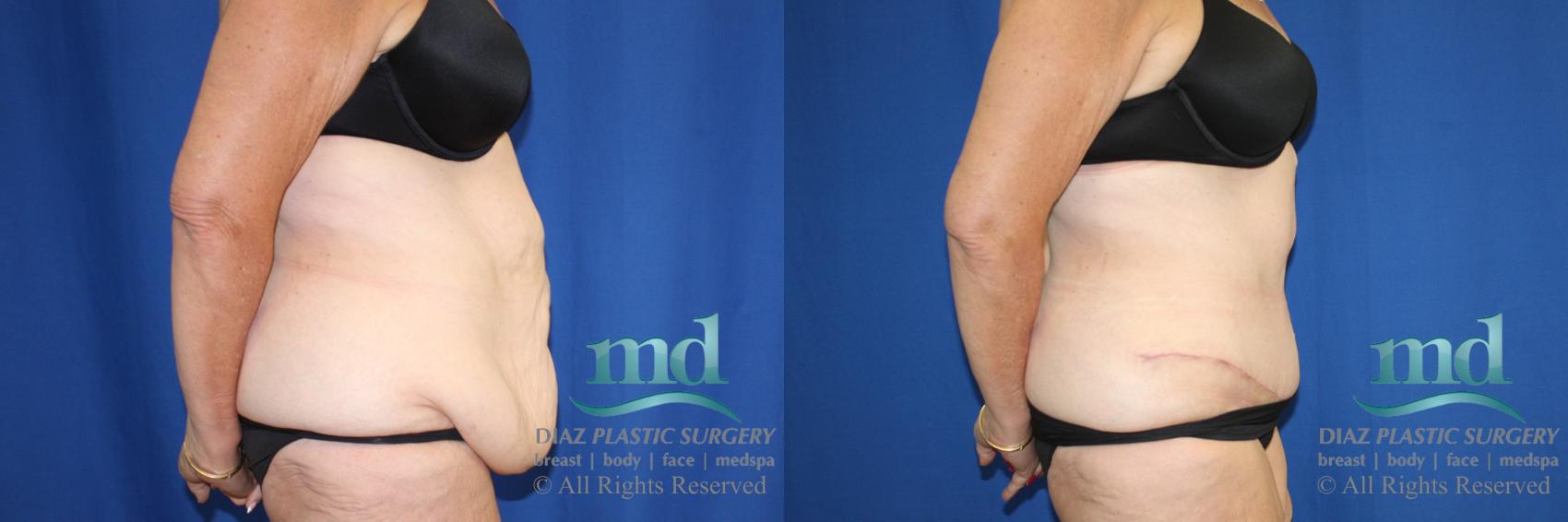 Before & After Liposuction Case 119 View #5 View in Melbourne, FL
