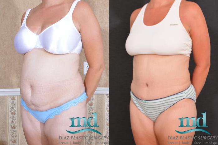 Before & After Liposuction Case 134 View #2 View in Melbourne, FL