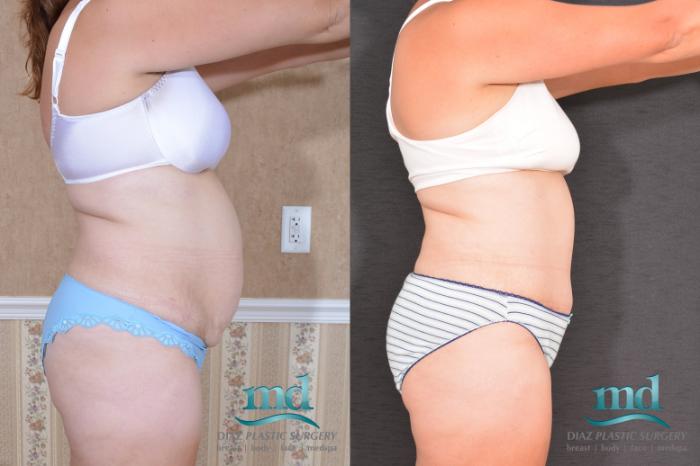 Before & After Liposuction Case 134 View #3 View in Melbourne, FL