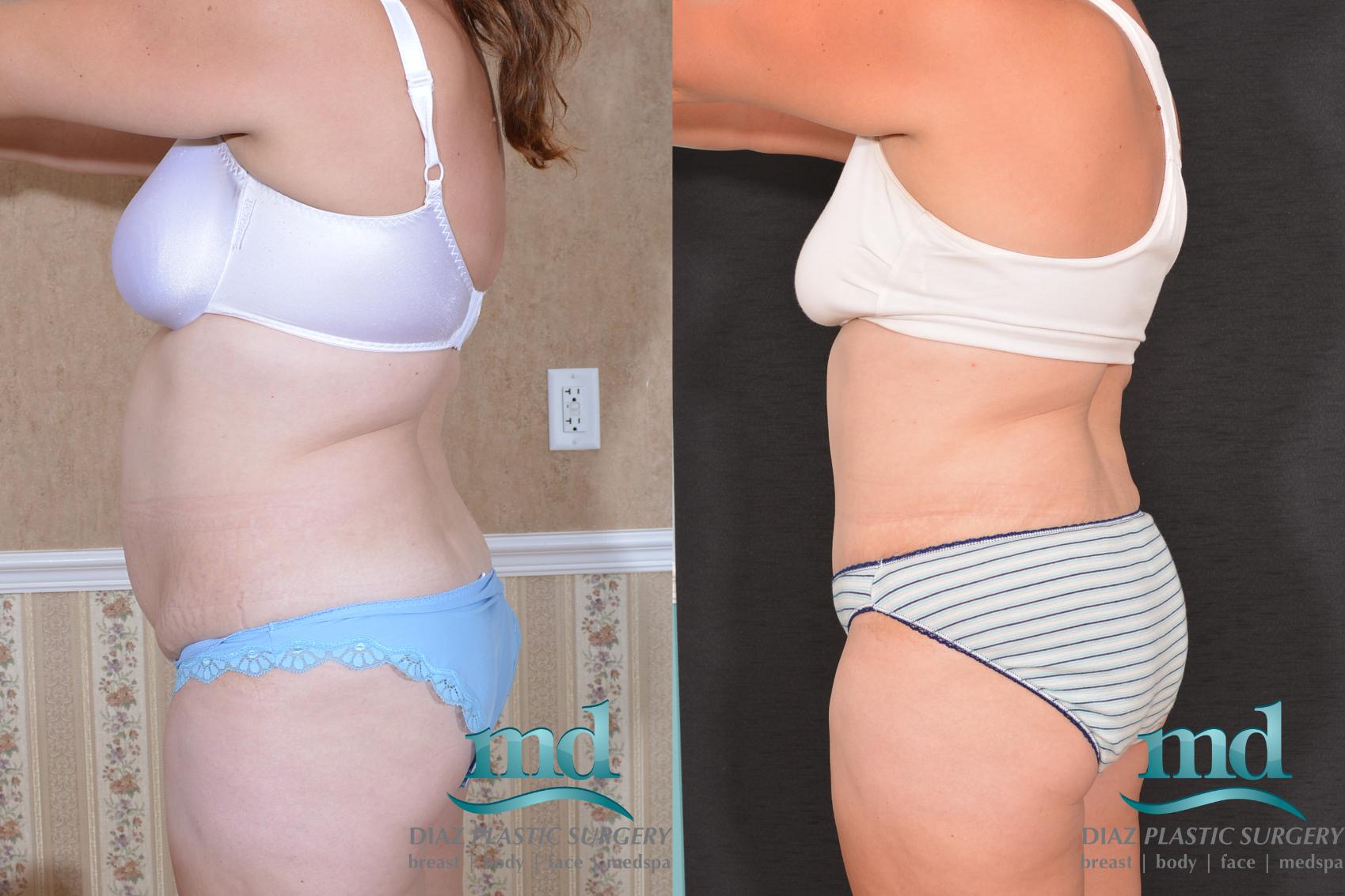 Before & After Liposuction Case 134 View #4 View in Melbourne, FL